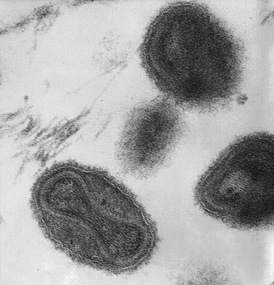 smallpox virus wikimedia