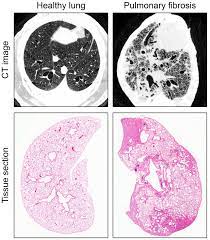 pulmonary fibrosis diagram